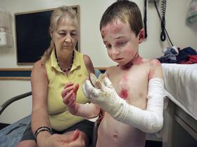 Dečku zamenjali 80 odstotkov kože, polne ran in brazgotin