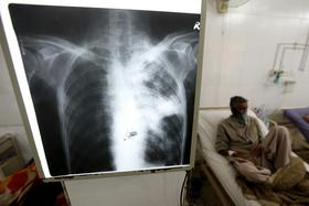 Tretjina svetovnega prebivalstva naj bi bila okužena s tuberkulozo