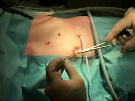 Slovenski kirurgi prvič otroku laparoskopsko odstranili tumor nadledvičnice