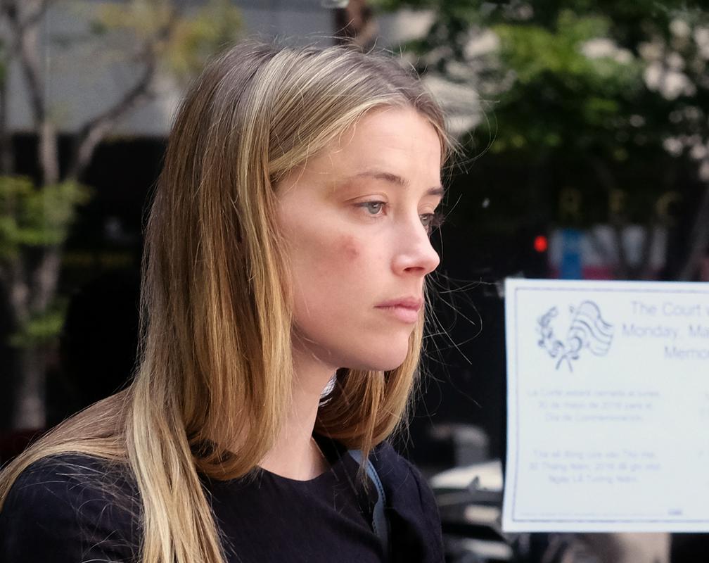 Amber Heard z modrico, ki naj bi ji jo povzročil Depp, ko da je vanjo zalučal mobitel. Foto: AP Amber Heard z modrico, ki naj bi ji jo povzročil Depp, ko da je vanjo zalučal mobitel. Foto: AP